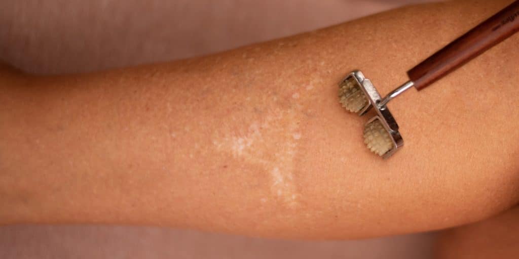 Terapia manual con rodillo de estimulación en cicatriz, método de liberación emocional por Anna Roca